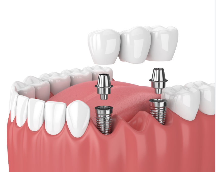 Dental Implants at MiNa Family Dentistry