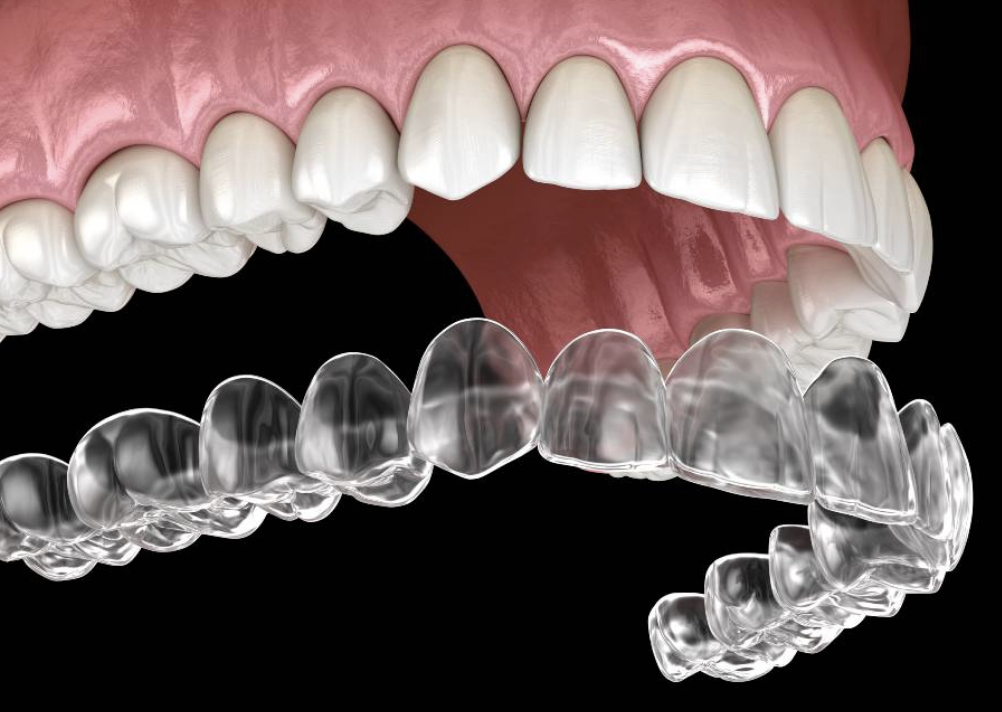 Invisalign at MiNa Family Dentistry