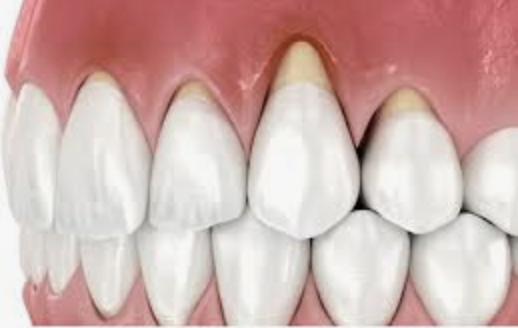 Periodontics at MiNa Family Dentistry