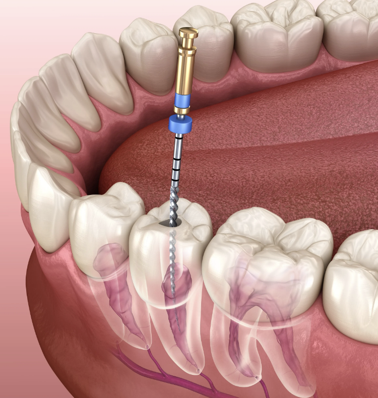 Root Canal at MiNa Family Dentistry