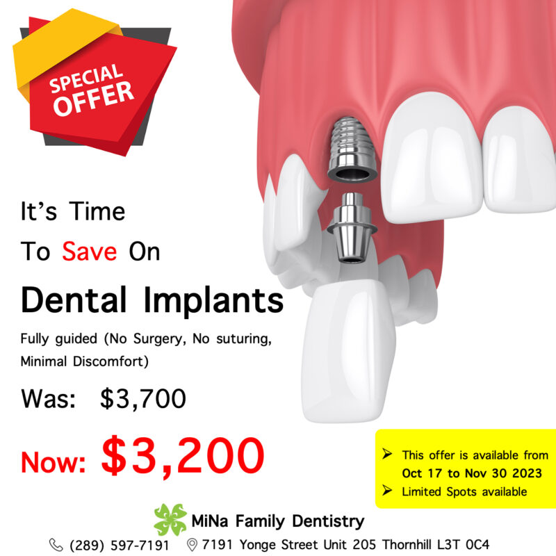 $500 Off on Fully guided Dental Implants