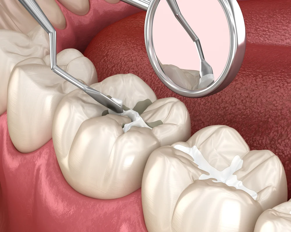dental fissure sealants