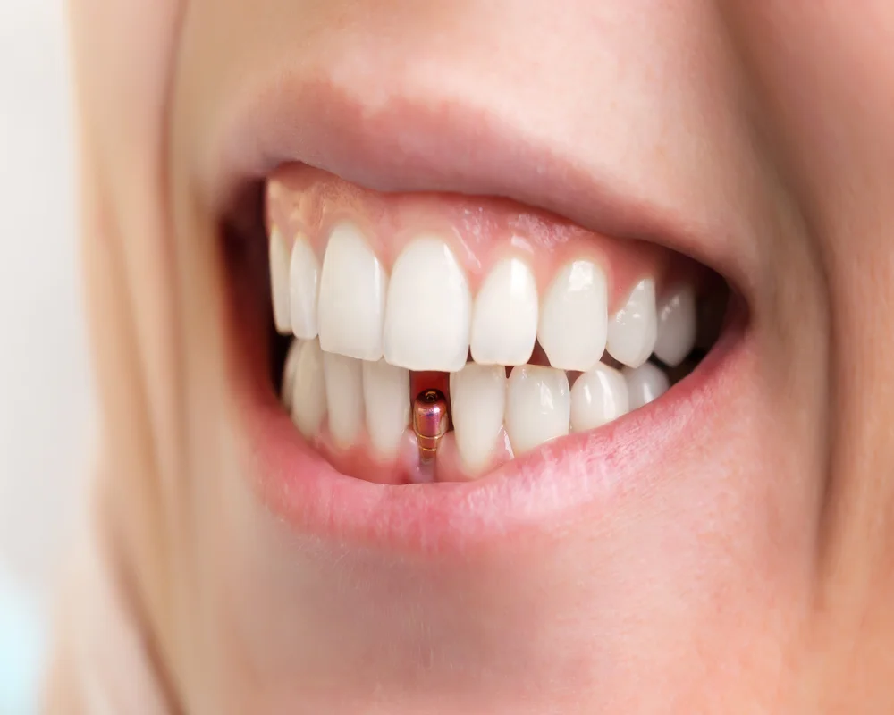 Dental implant placement by specialist Dr. Mehdi Adibrad at MiNa Family Dentistry in Thornhill