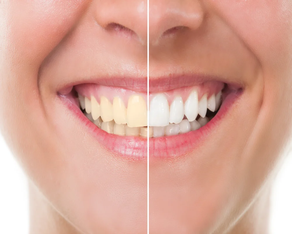 Zoom professional teeth whitening treatment at MiNa Family Dentistry Thornhill