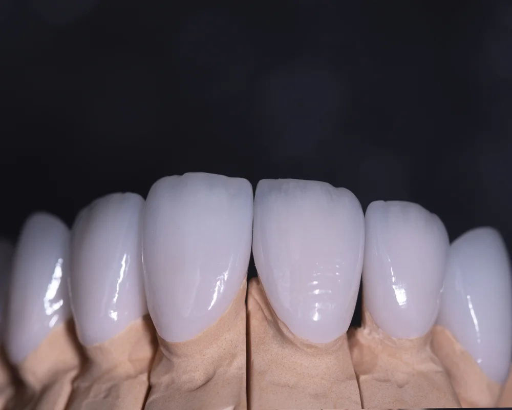 Porcelain veneers smile transformation at MiNa Family Dentistry Thornhill