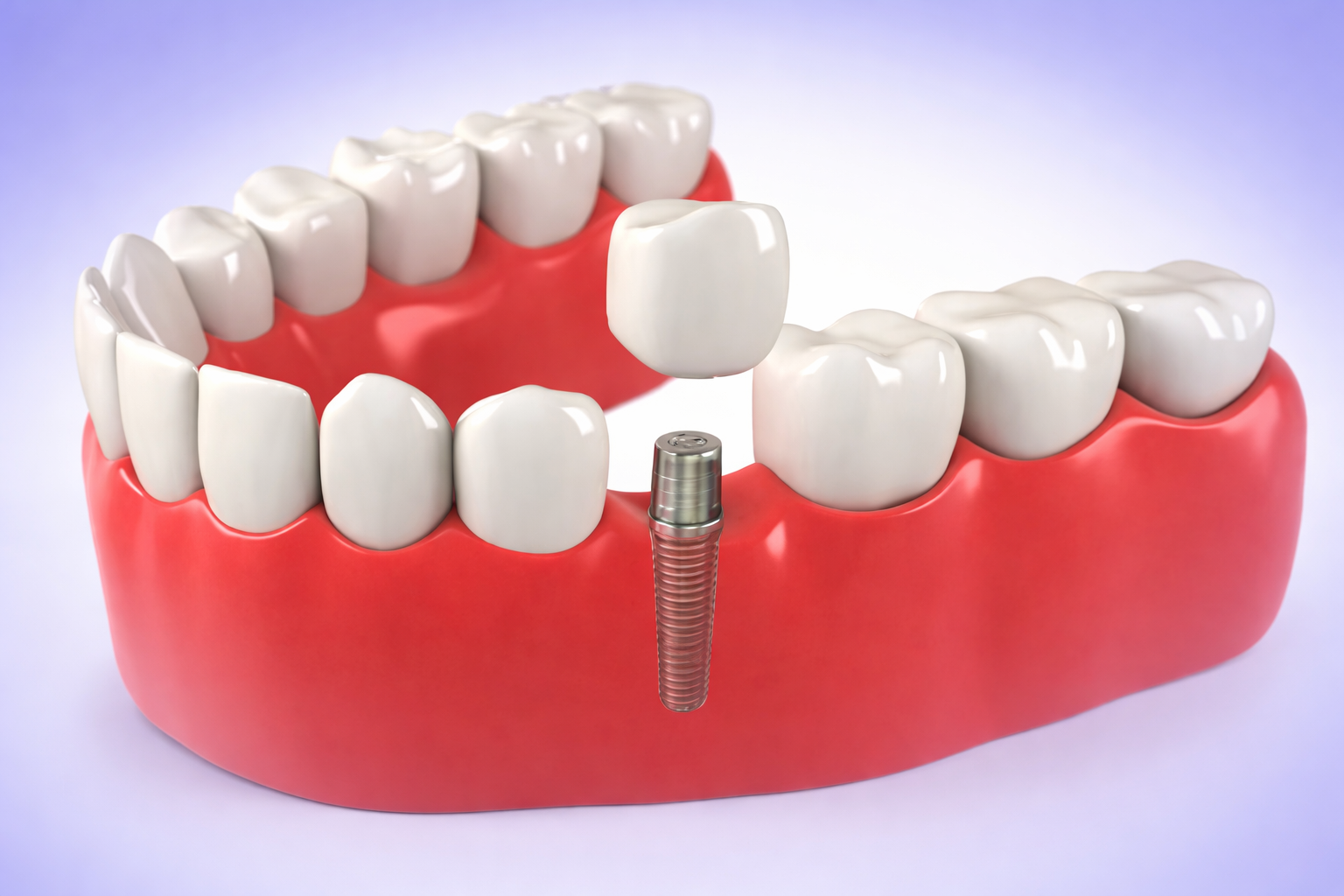 Same day dental implant in Thornhill