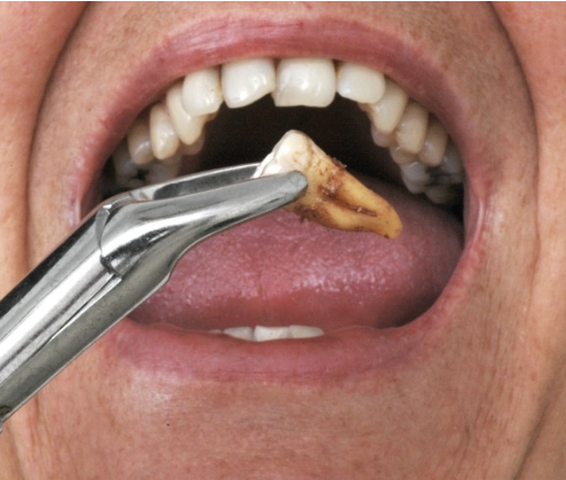 Emergency tooth extraction