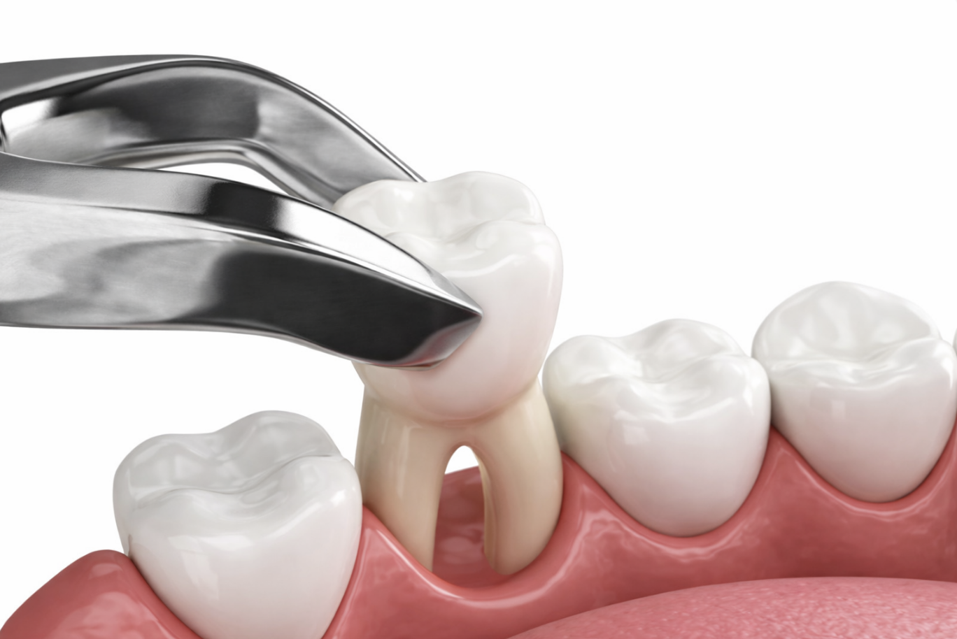 Emergency tooth extraction