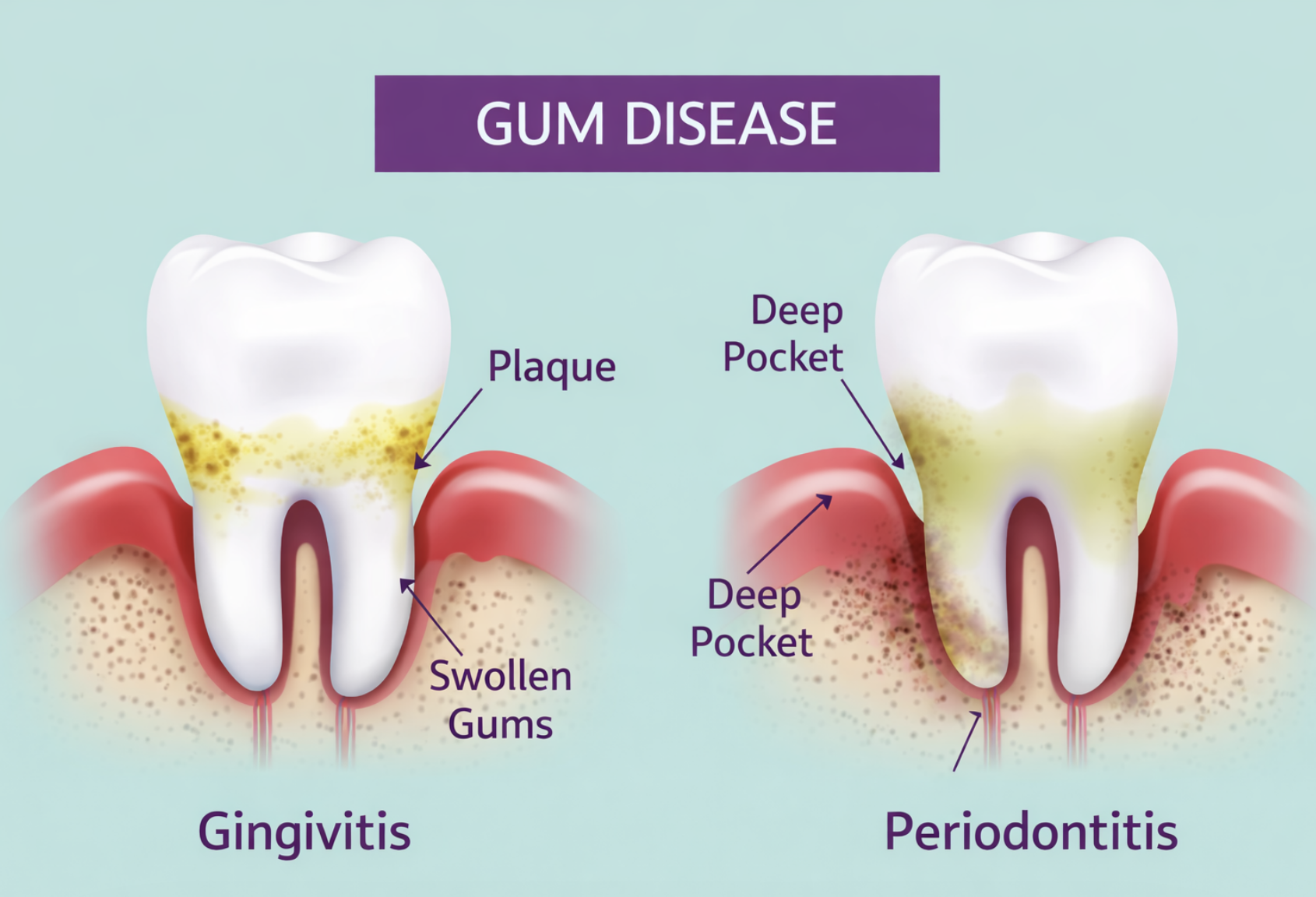 Gum Disease