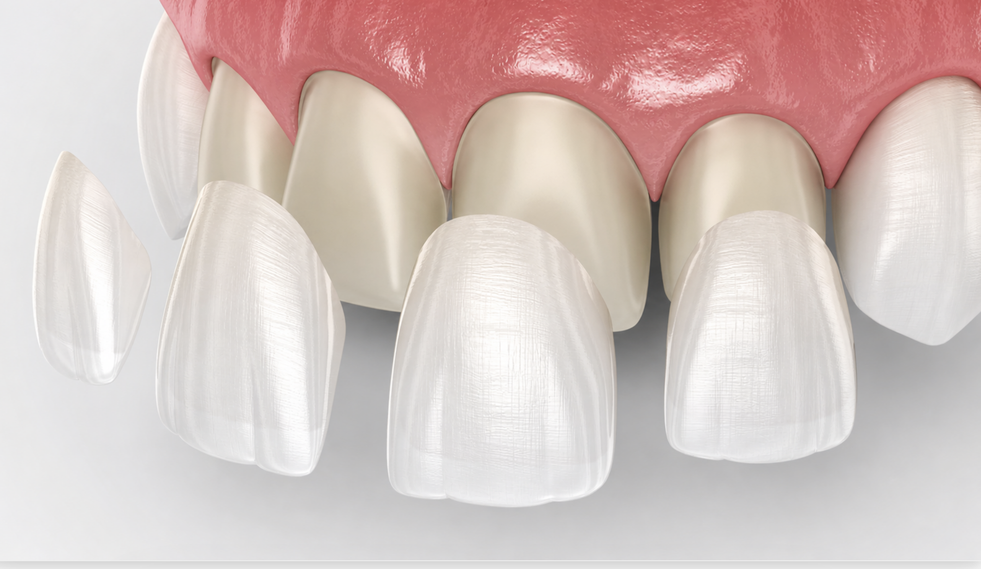procelain veneers vaughan