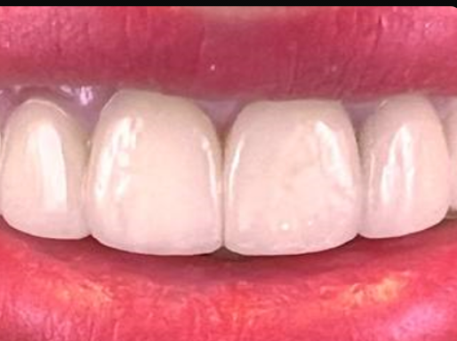 After: even, bright smile restored with composite veneers