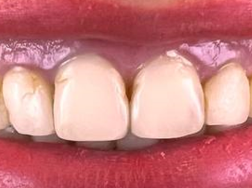 Before: uneven, slightly discoloured front teeth with gaps