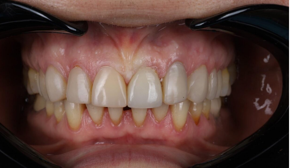 After: gap restored with implant and composite veneers