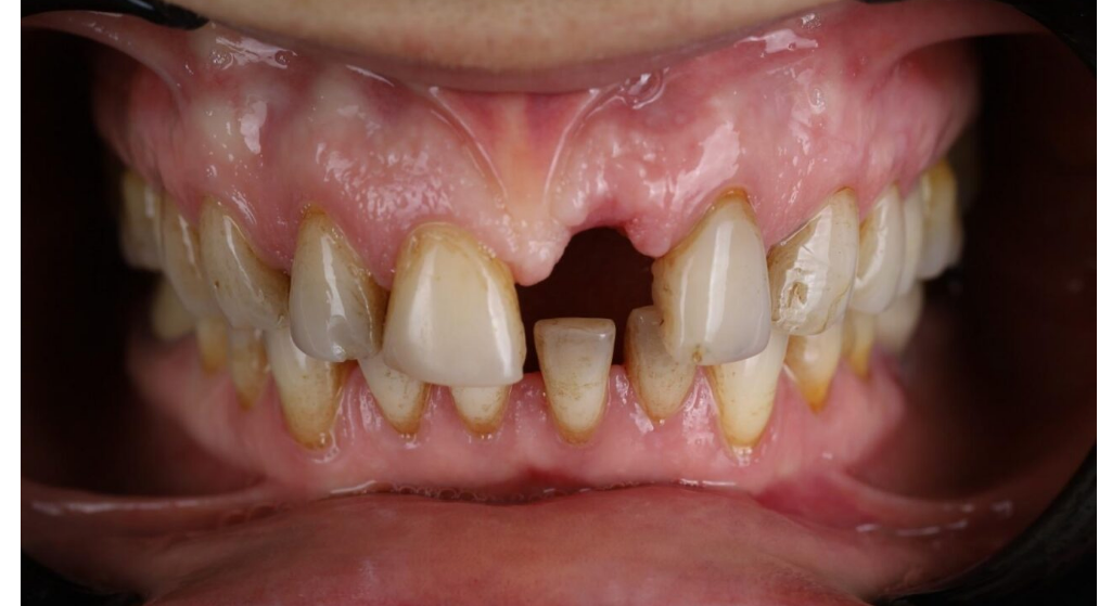 Before: missing front tooth and worn, discoloured teeth