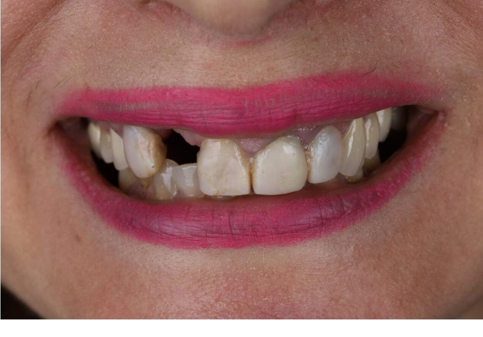 Before: missing tooth and uneven front teeth