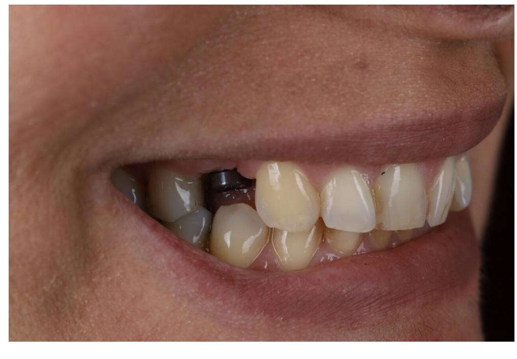 Before: exposed implant abutment where a tooth was missing